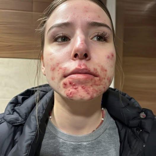 Understanding Chin & Jawline Acne: Causes, Context, and Compassionate Solutions