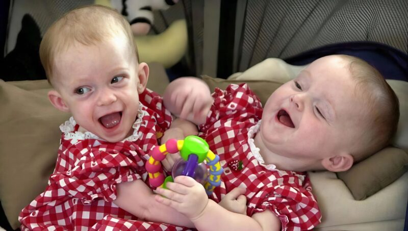 Doctors separated conjoined twins born connected at the chest: Here’s what they look like 25 years later