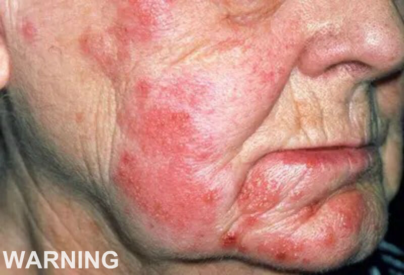 This is the silent disease that is triggered when you come into contact with …