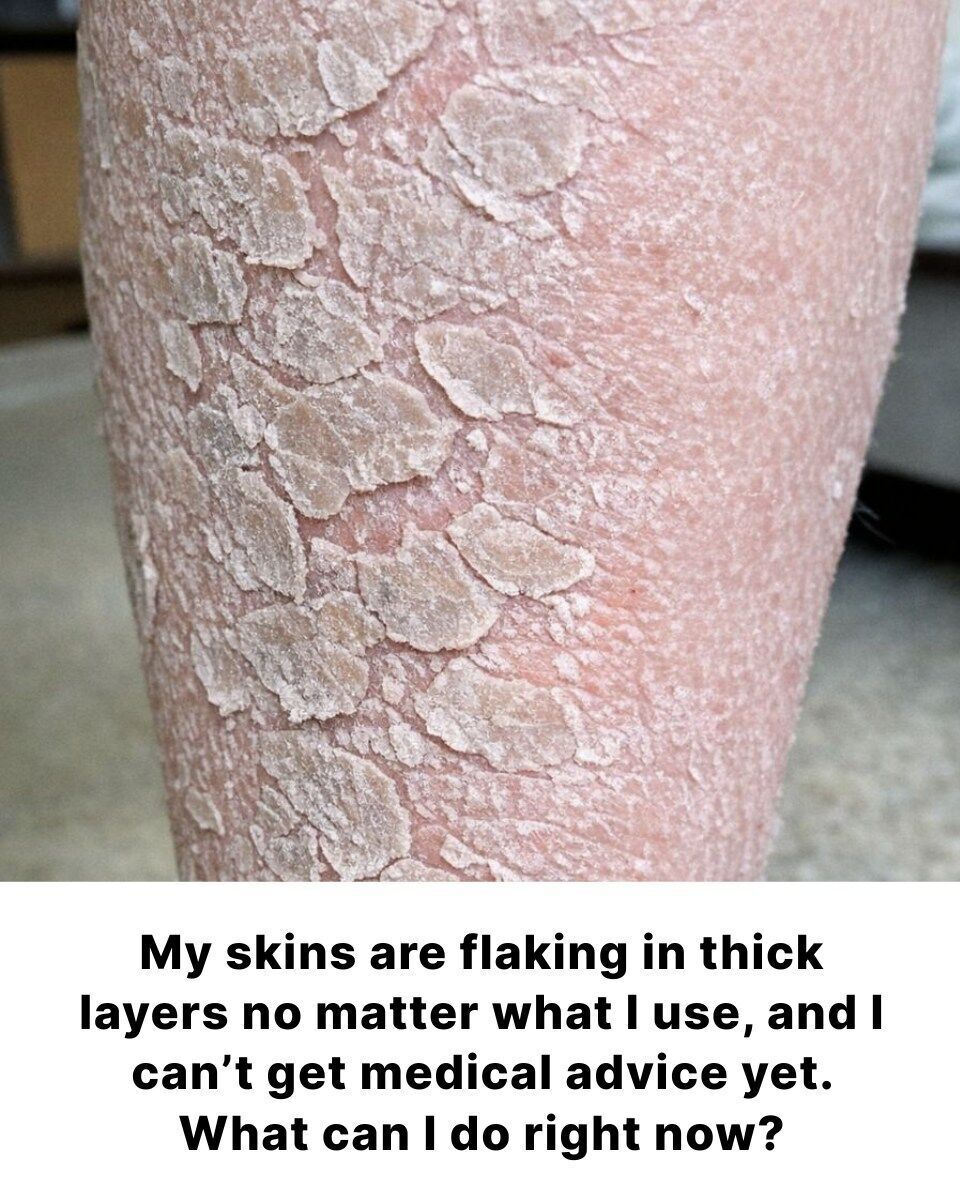 My skins are flaking in thick layers no matter what I use, and I can’t get medical advice yet. What can I do right now?