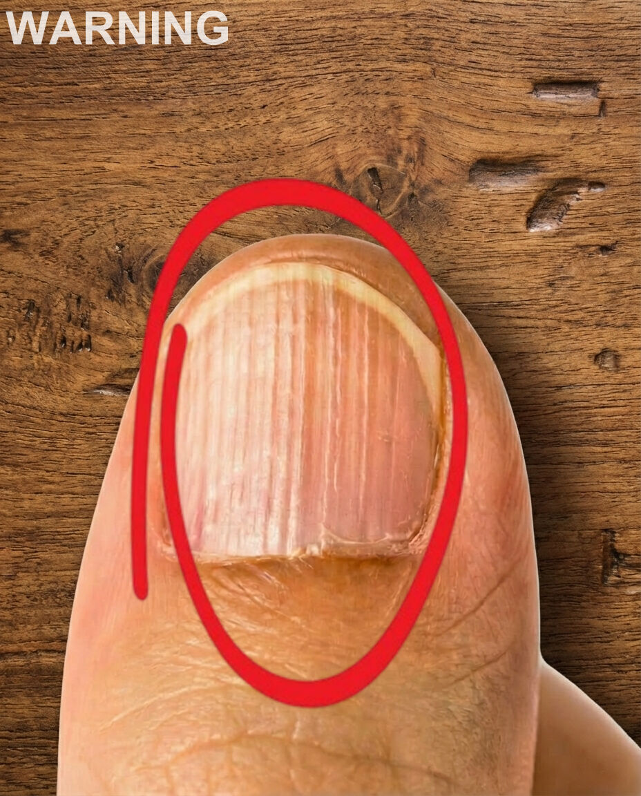 If you have lines on your nails, it means you have ca..